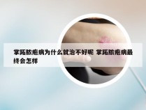 掌跖脓疱病为什么就治不好呢 掌跖脓疱病最终会怎样