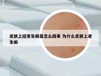 皮肤上经常生癣是怎么回事 为什么皮肤上老生癣