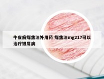 牛皮癣煤焦油外用药 煤焦油mg217可以治疗银屑病