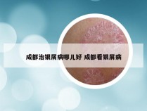 成都治银屑病哪儿好 成都看银屑病