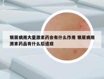 银屑病用大量激素药会有什么作用 银屑病用激素药品有什么后遗症