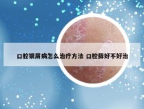 口腔银屑病怎么治疗方法 口腔藓好不好治
