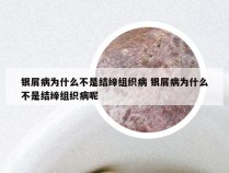 银屑病为什么不是结缔组织病 银屑病为什么不是结缔组织病呢