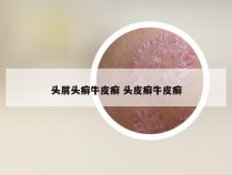 头屑头癣牛皮癣 头皮癣牛皮癣