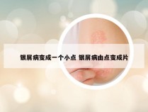 银屑病变成一个小点 银屑病由点变成片