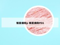 银屑病和p 银屑病和PD1