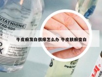 牛皮癣发白很痒怎么办 牛皮肤癣变白