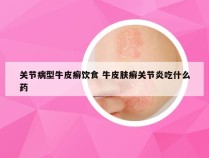 关节病型牛皮癣饮食 牛皮肤癣关节炎吃什么药