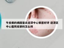 牛皮癣的病因皆去迎泽中心银屑好评 迎泽区中心医院皮肤科怎么样