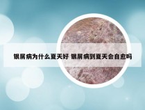 银屑病为什么夏天好 银屑病到夏天会自愈吗