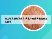 头上牛皮癣头发变白 头上牛皮癣头发变白怎么回事