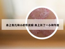 身上有几块小的牛皮癣 身上长了一小块牛皮