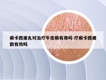 癣卡西甫丸对治疗牛皮癣有用吗 疗癣卡西甫散有效吗