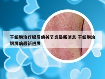 干细胞治疗银屑病关节炎最新消息 干细胞冶银屑病最新进展