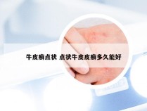牛皮癣点状 点状牛皮皮癣多久能好