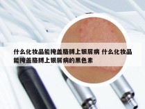 什么化妆品能掩盖胳膊上银屑病 什么化妆品能掩盖胳膊上银屑病的黑色素