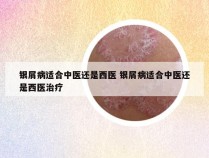 银屑病适合中医还是西医 银屑病适合中医还是西医治疗