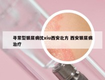寻常型银屑病优xiu西安北方 西安银屑病治疗