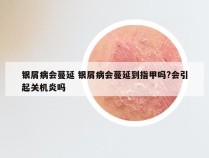 银屑病会蔓延 银屑病会蔓延到指甲吗?会引起关机炎吗