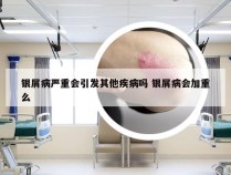 银屑病严重会引发其他疾病吗 银屑病会加重么