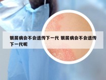 银屑病会不会遗传下一代 银屑病会不会遗传下一代呢