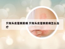 只有头皮是银屑病 只有头皮是银屑病怎么治疗