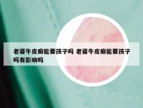 老婆牛皮癣能要孩子吗 老婆牛皮癣能要孩子吗有影响吗