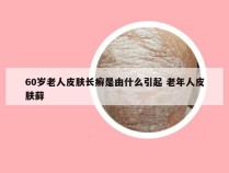 60岁老人皮肤长癣是由什么引起 老年人皮肤藓