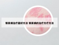 银屑病治疗最好方法 银屑病的治疗方疗方法