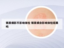 银屑病影不影响体检 银屑病会影响体检结果吗