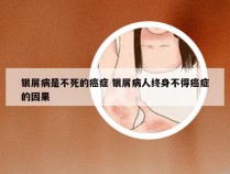 银屑病是不死的癌症 银屑病人终身不得癌症的因果