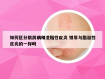 如何区分银屑病和溢脂性皮炎 银屑与脂溢性皮炎的一样吗