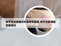 四平牛皮癣最好的是哪家医院 四平皮肤病医院哪家好