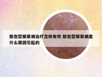 脓包型银屑病治疗怎样有效 脓包型银屑病是什么原因引起的