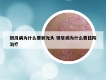 银屑病为什么要剃光头 银屑病为什么要住院治疗