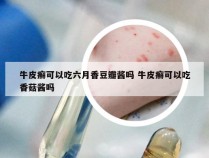 牛皮癣可以吃六月香豆瓣酱吗 牛皮癣可以吃香菇酱吗