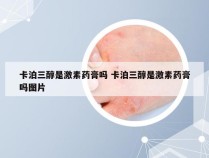 卡泊三醇是激素药膏吗 卡泊三醇是激素药膏吗图片