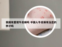我国有重视牛皮癣吗 中国人牛皮癣有治愈的例子吗