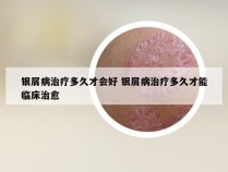 银屑病治疗多久才会好 银屑病治疗多久才能临床治愈