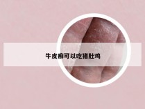 牛皮癣可以吃猪肚鸡