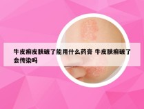 牛皮癣皮肤破了能用什么药膏 牛皮肤癣破了会传染吗