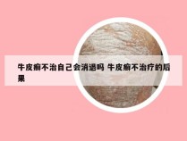 牛皮癣不治自己会消退吗 牛皮癣不治疗的后果