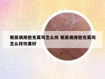 银屑病用他克莫司怎么样 银屑病用他克莫司怎么样效果好