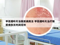 甲氨蝶呤片治银屑病用法 甲氨蝶呤片治疗银屑病多长时间见效