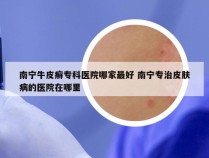 南宁牛皮癣专科医院哪家最好 南宁专治皮肤病的医院在哪里