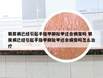银屑病已经引起手指甲脚趾甲还会病变吗 银屑病已经引起手指甲脚趾甲还会病变吗怎么治疗