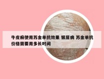 牛皮癣使用苏金单抗效果 银屑病 苏金单抗价格需要用多长时间