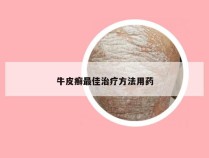 牛皮癣最佳治疗方法用药