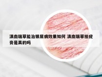 滇南瑞草能治银屑病效果如何 滇南瑞草祛疣膏是真的吗