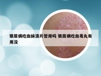 银屑病吃血脉清片管用吗 银屑病吃血毒丸有用没